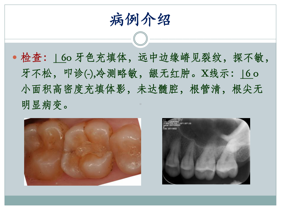 隐裂牙金属全冠修复一例课件.ppt_第3页