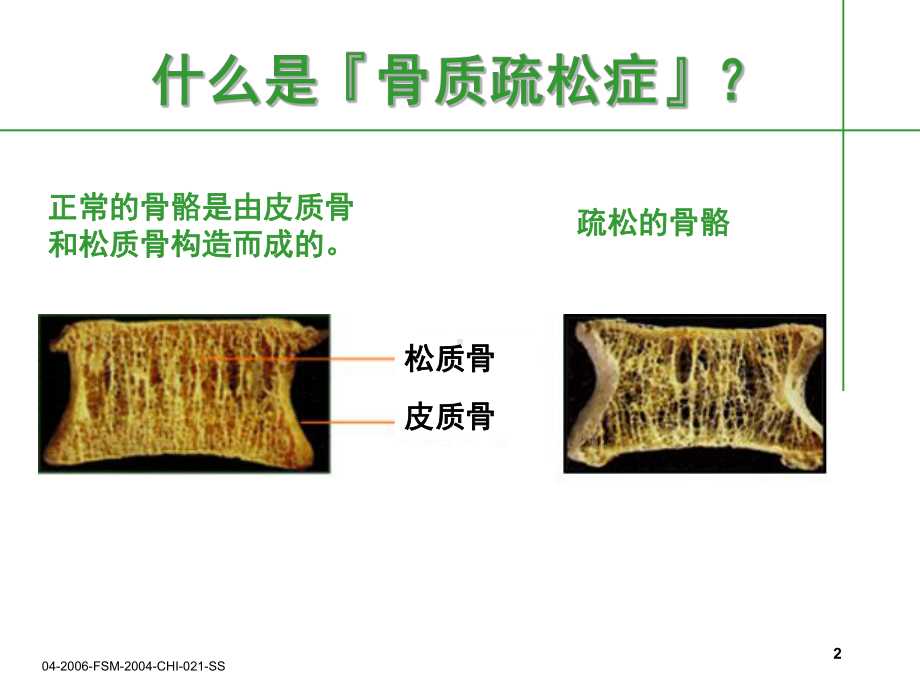 糖尿病与骨质疏松症课件.ppt_第2页