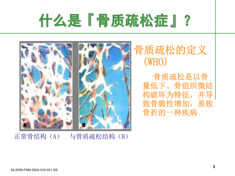 糖尿病与骨质疏松症课件.ppt_第3页