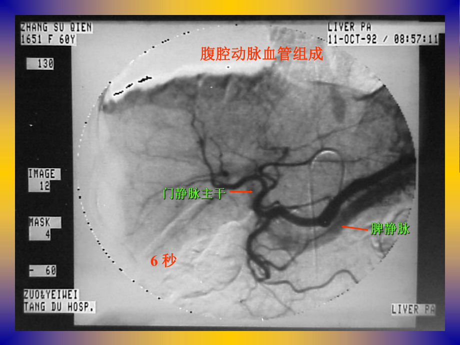 肝肿瘤的介入治疗课件.ppt_第3页
