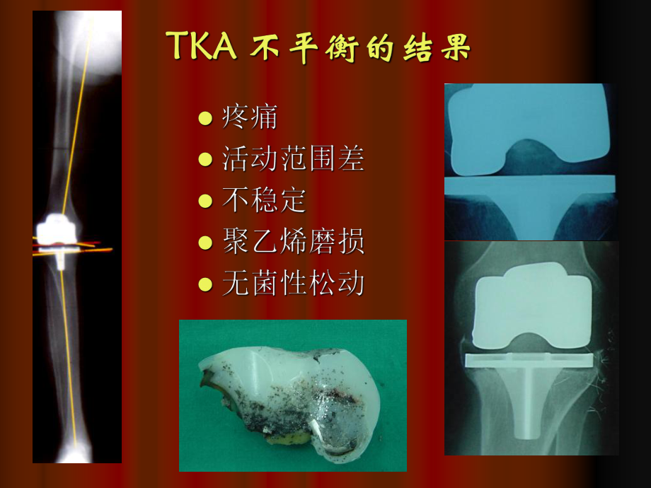 TKA中软组织平衡的原则课件.ppt_第3页