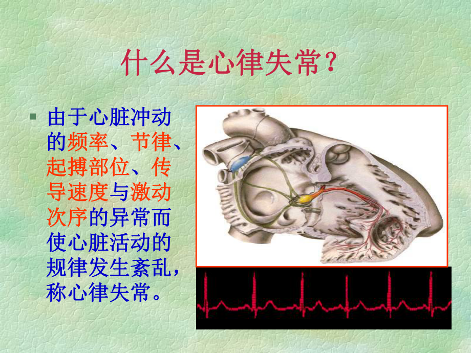 ICU常见之心律失常课件.ppt_第2页