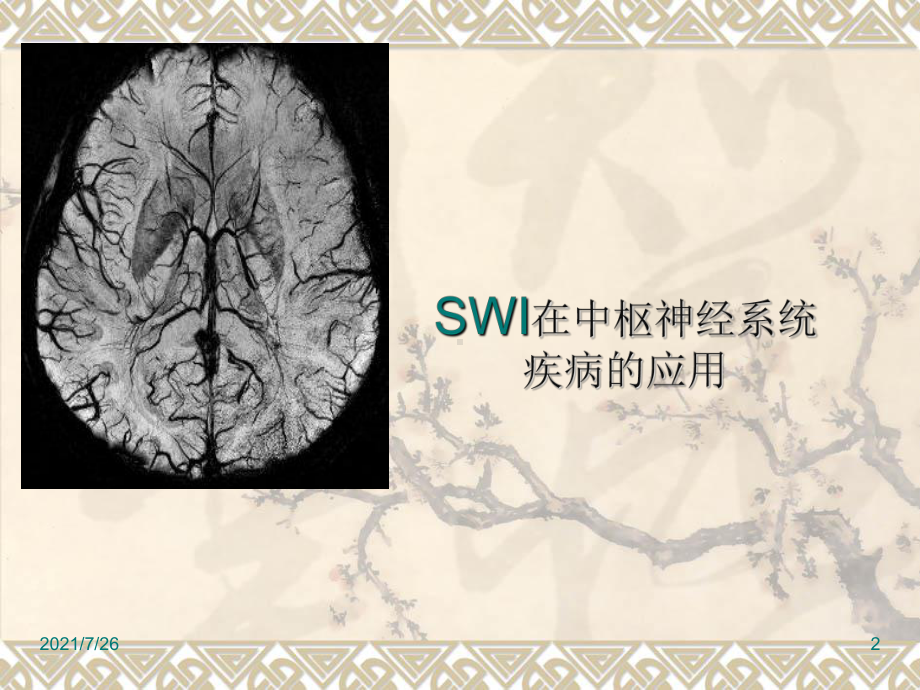 SWI在中枢神经系统应用课件.ppt_第2页