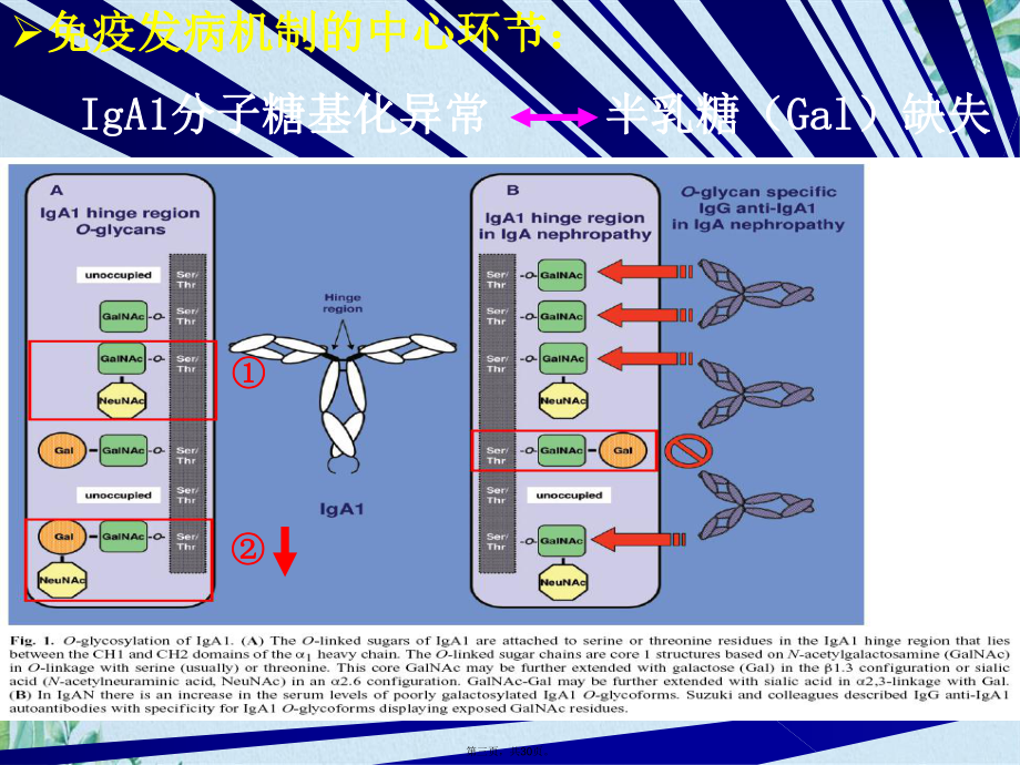 IgA肾病免疫发病机制及免疫抑制治疗(共30张PPT)课件.pptx_第3页