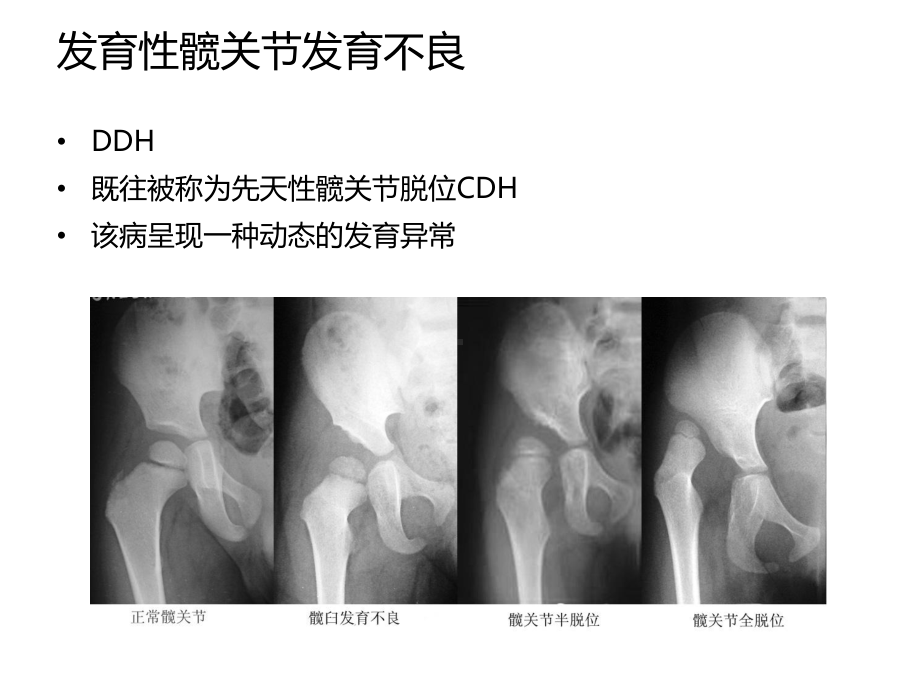 Pavlik吊带方法治疗个月以内的发育性髋关节发育不良课件.ppt_第2页