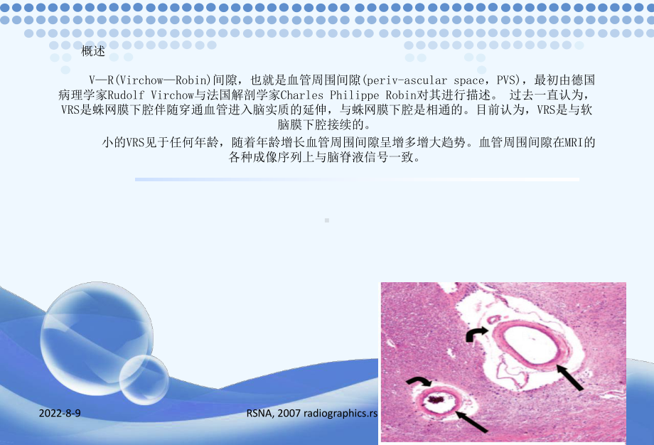 V-R间隙MR成像表现课件1.ppt_第2页