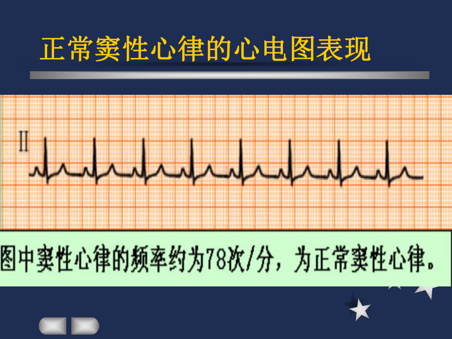 -窦性心律失常课件.ppt_第3页