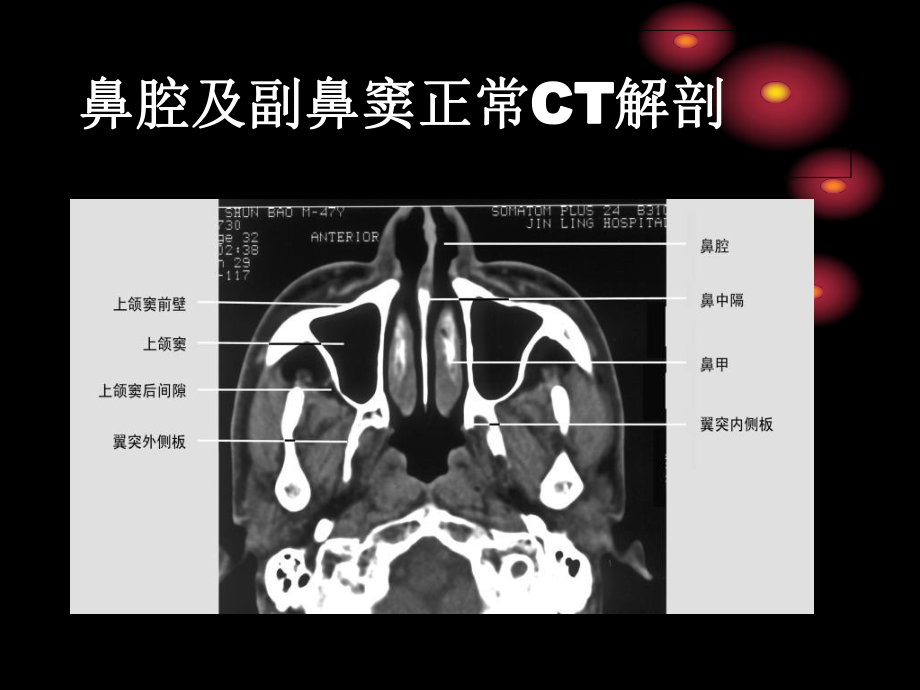 鼻和鼻窦病变CT诊断-PPT课件.ppt_第1页