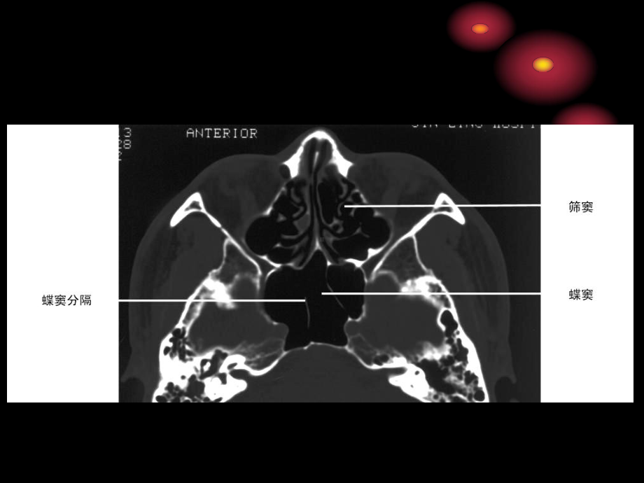 鼻和鼻窦病变CT诊断-PPT课件.ppt_第2页