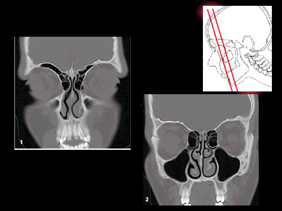 鼻和鼻窦病变CT诊断-PPT课件.ppt_第3页