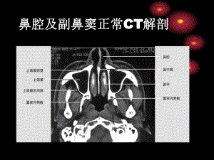 鼻和鼻窦病变CT诊断-PPT课件.ppt