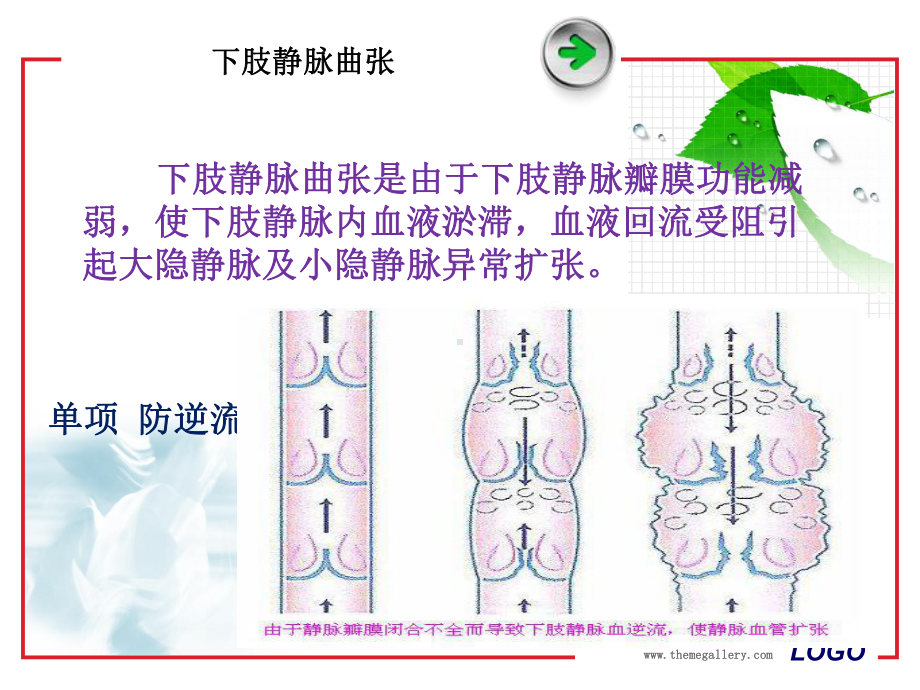 -下肢静脉曲张的预防和治疗-课件.ppt_第3页