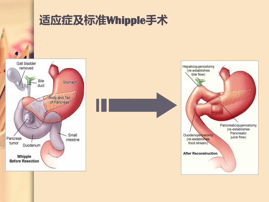 Whipple术围手术期护理课件.ppt_第3页