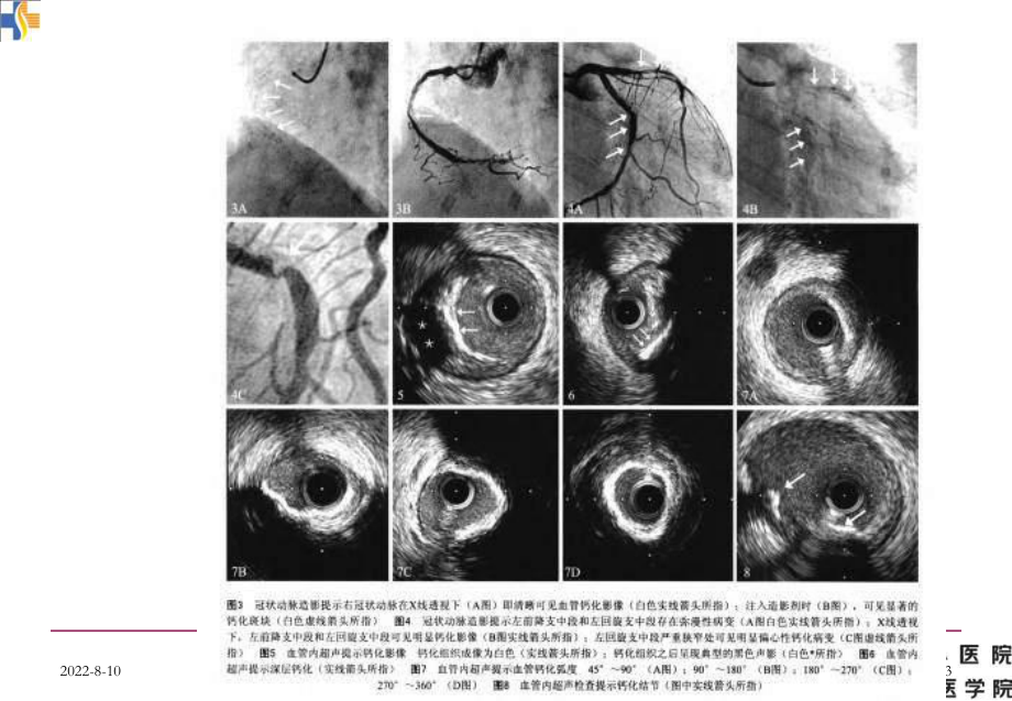 严重冠状动脉钙化病变治疗策略-精选课件.ppt_第3页