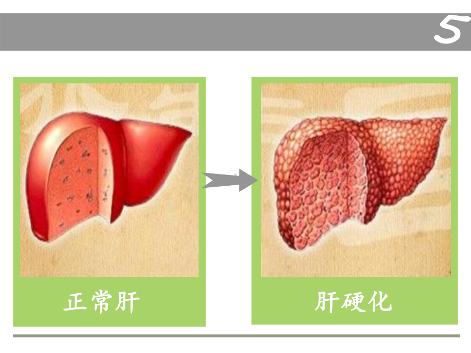 (完整版)肝硬化ppt课件.ppt_第3页