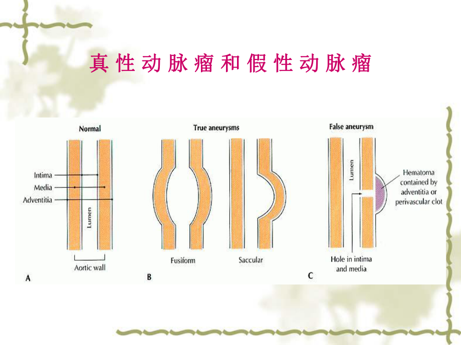 大血管手术麻醉及相关问题课件.ppt_第3页