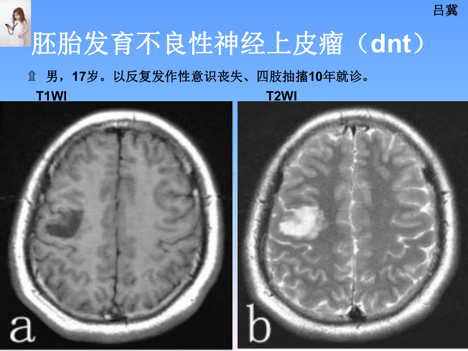 医影在线CNS疾病影像图库(2)76张幻灯片.ppt_第2页