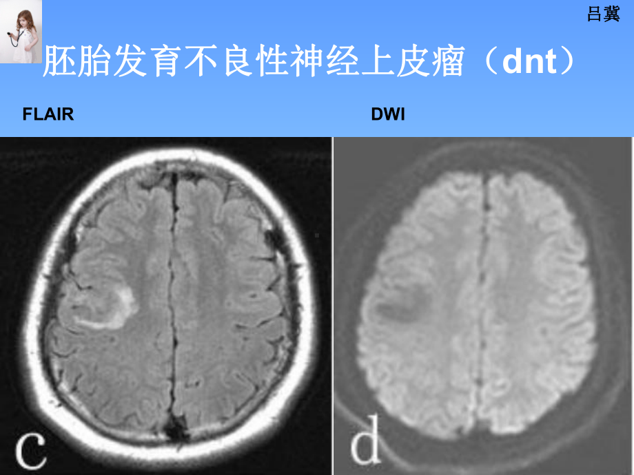 医影在线CNS疾病影像图库(2)76张幻灯片.ppt_第3页