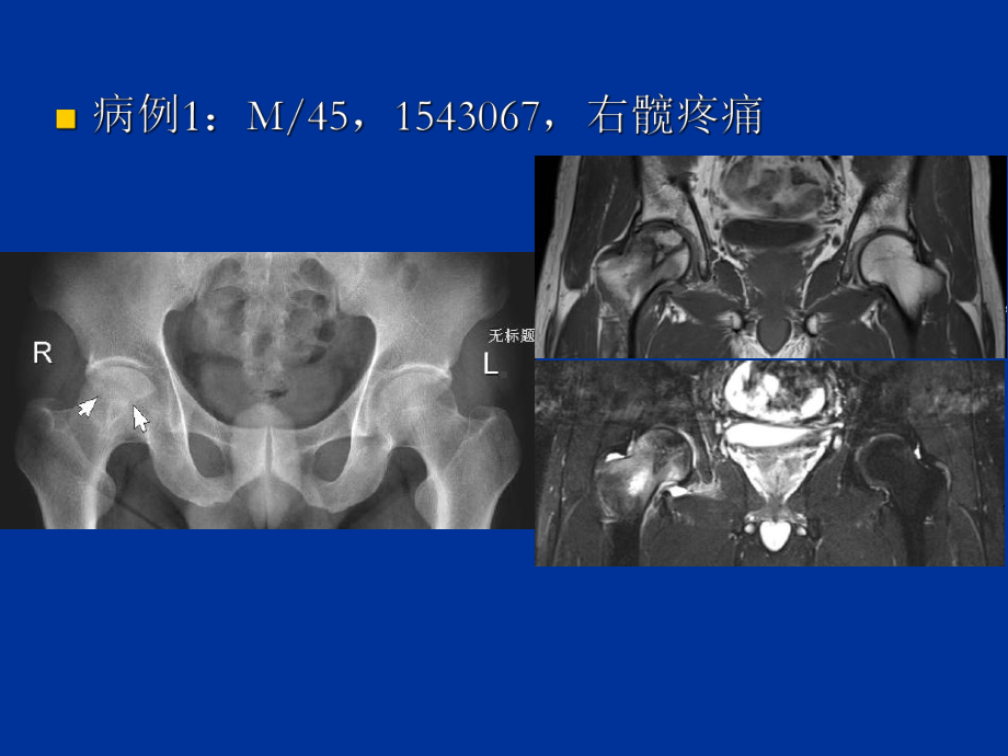 中青年髋关节疼痛的影像鉴别诊断-70页PPT课件.ppt_第2页