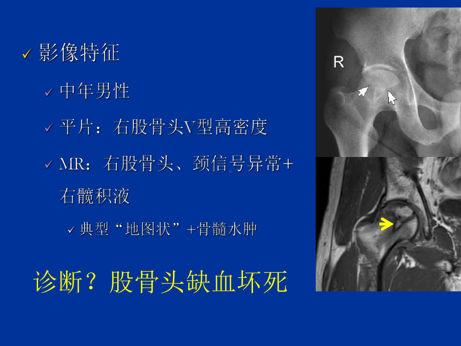 中青年髋关节疼痛的影像鉴别诊断-70页PPT课件.ppt_第3页