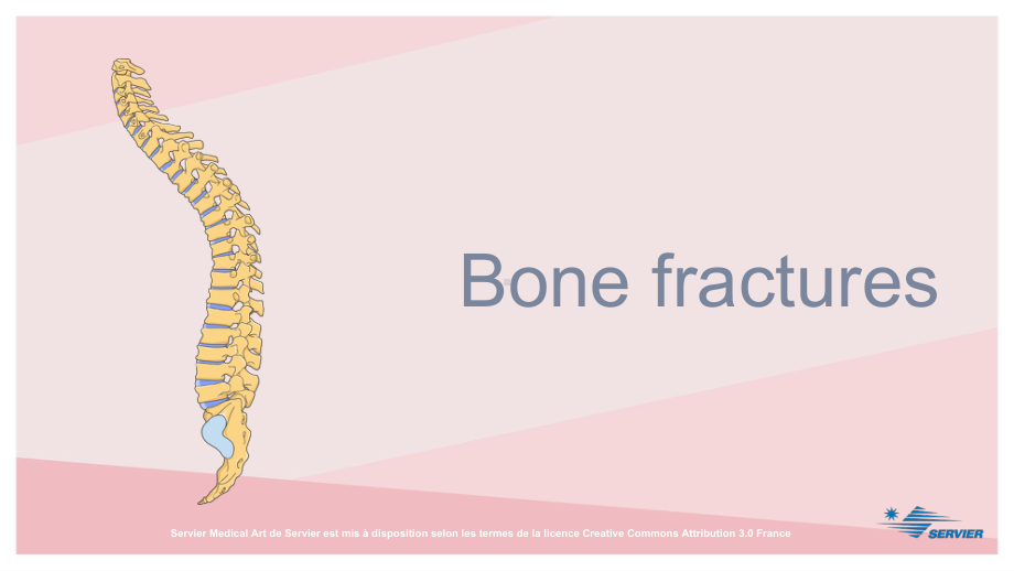 医学科研教学绘图可编辑素材之骨折Bone-fractures课件.ppt_第2页