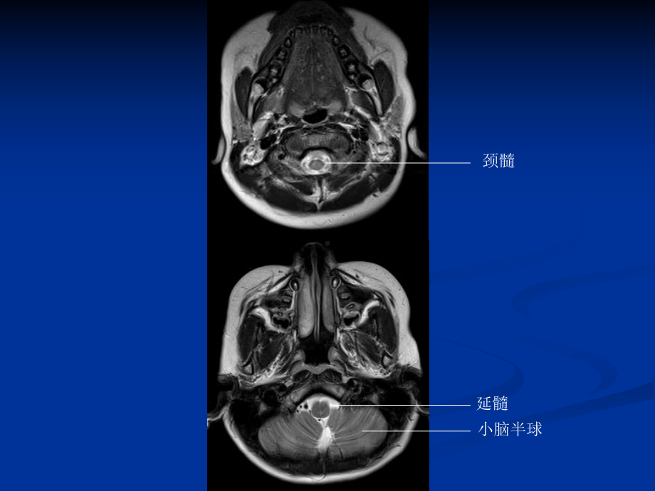 头颅CT与MRI的正常图像课件.ppt_第2页