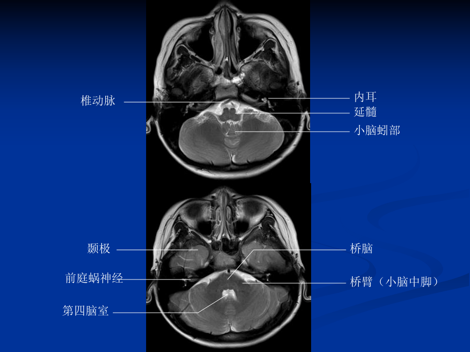 头颅CT与MRI的正常图像课件.ppt_第3页