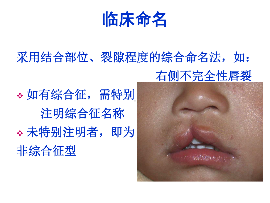 口腔唇、腭裂及面裂课件.ppt_第3页