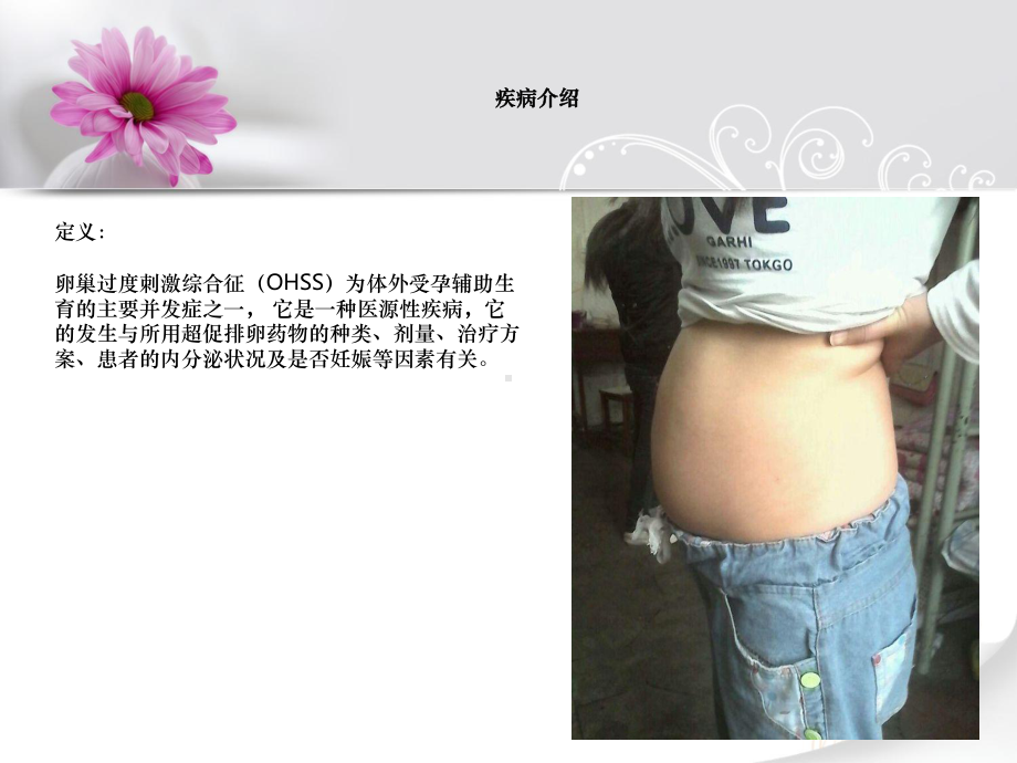 卵巢过度刺激综合征(OHSS)护理查房课件.ppt_第2页