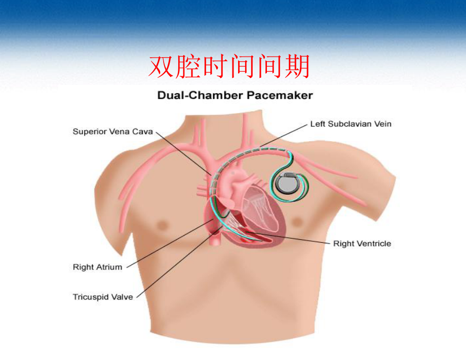 双腔起搏器时间间期基础-PPT课件.ppt_第3页