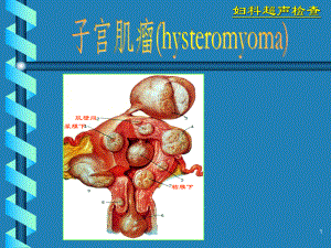 妇科超声诊断学-子宫肌瘤-PPT课件.ppt