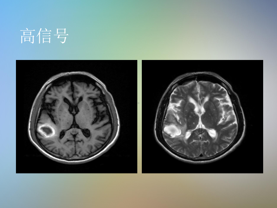 中枢神经系统疾病MRI基本阅片技能byimagingdoctor课件.pptx_第3页