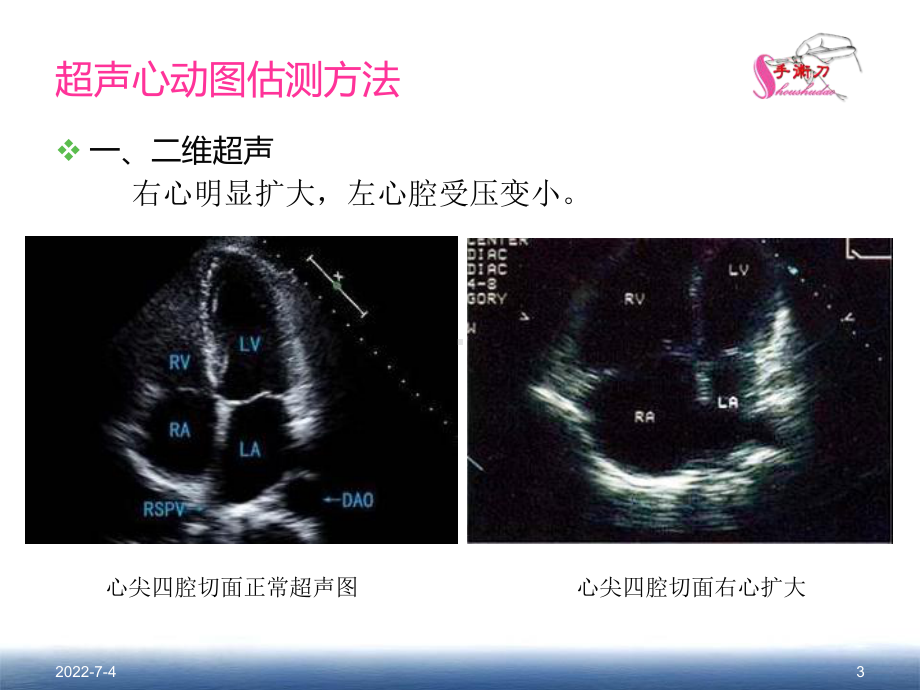 肺动脉高压的超声估测量方法30页PPT课件.ppt_第3页