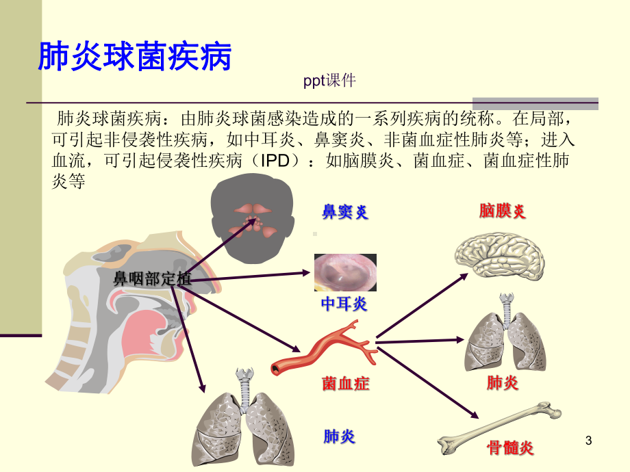 肺炎球菌流行病学及预防-ppt课件.ppt_第3页