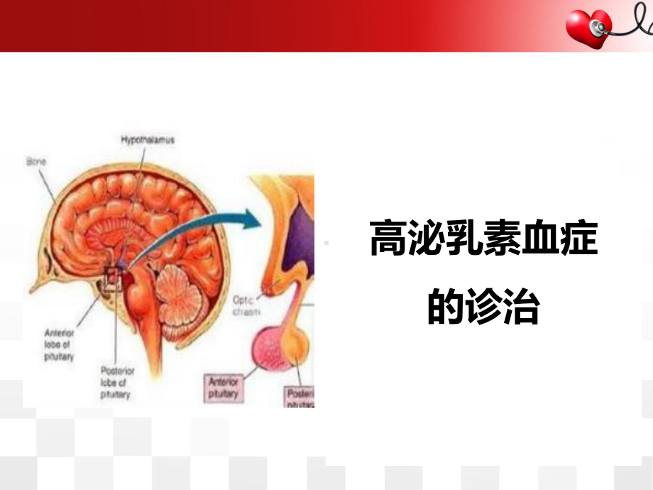 高泌乳素血症治疗精品PPT课件.pptx_第1页