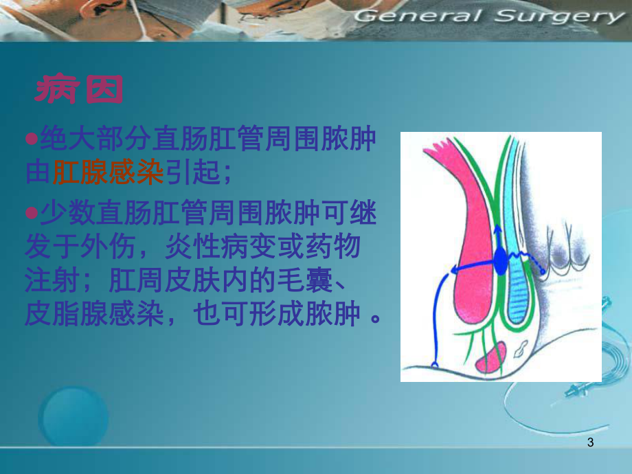 肛周脓肿ppt课件.ppt_第3页