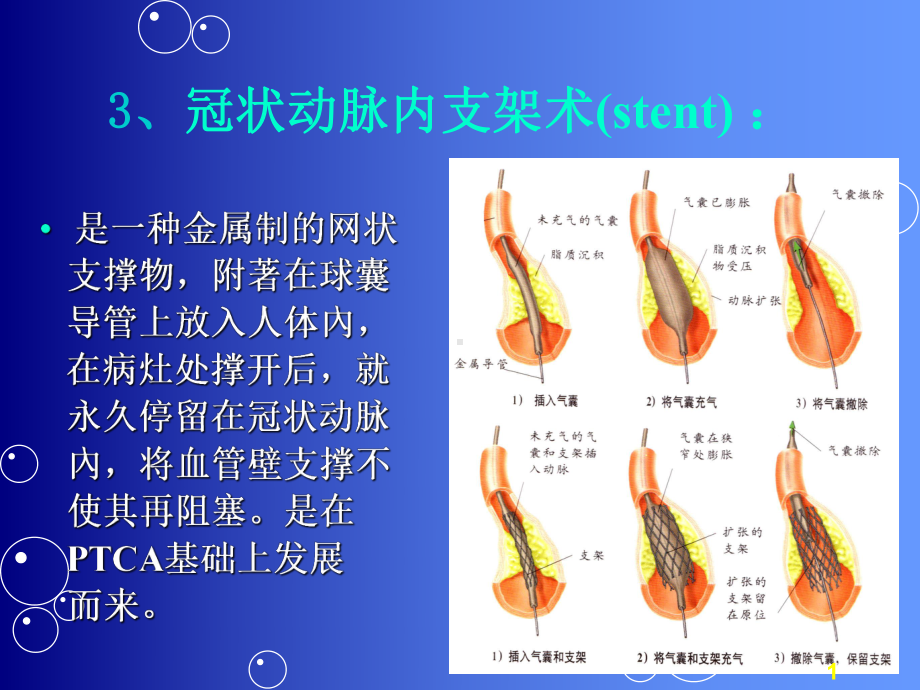 心血管病介入护理PPT课件.ppt_第1页