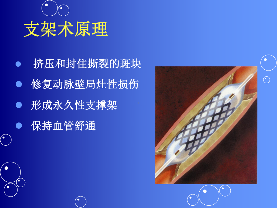 心血管病介入护理PPT课件.ppt_第3页