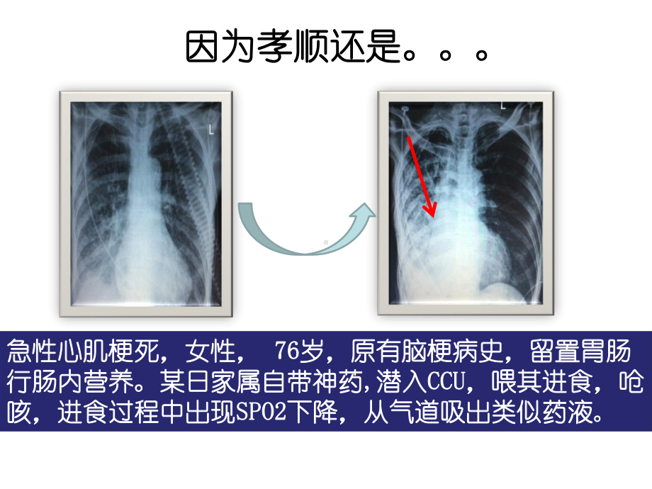 误吸与吸入性肺炎治疗与护理课件.pptx_第2页