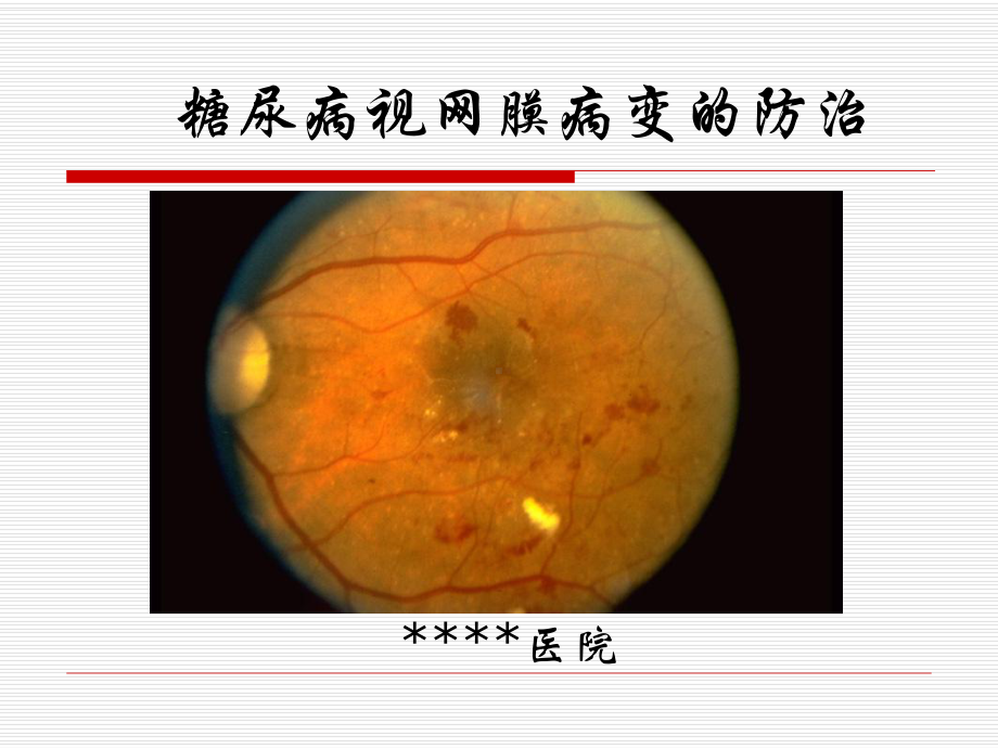 糖尿病视网膜病变宣教课件.ppt_第1页