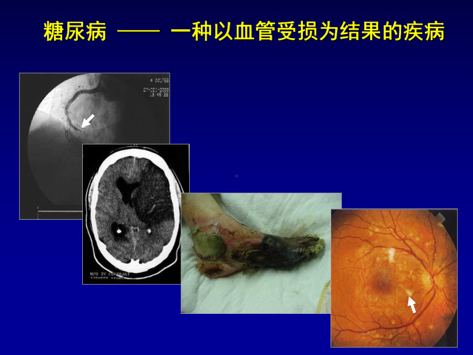 糖尿病大血管并发症PPT课件.ppt_第2页