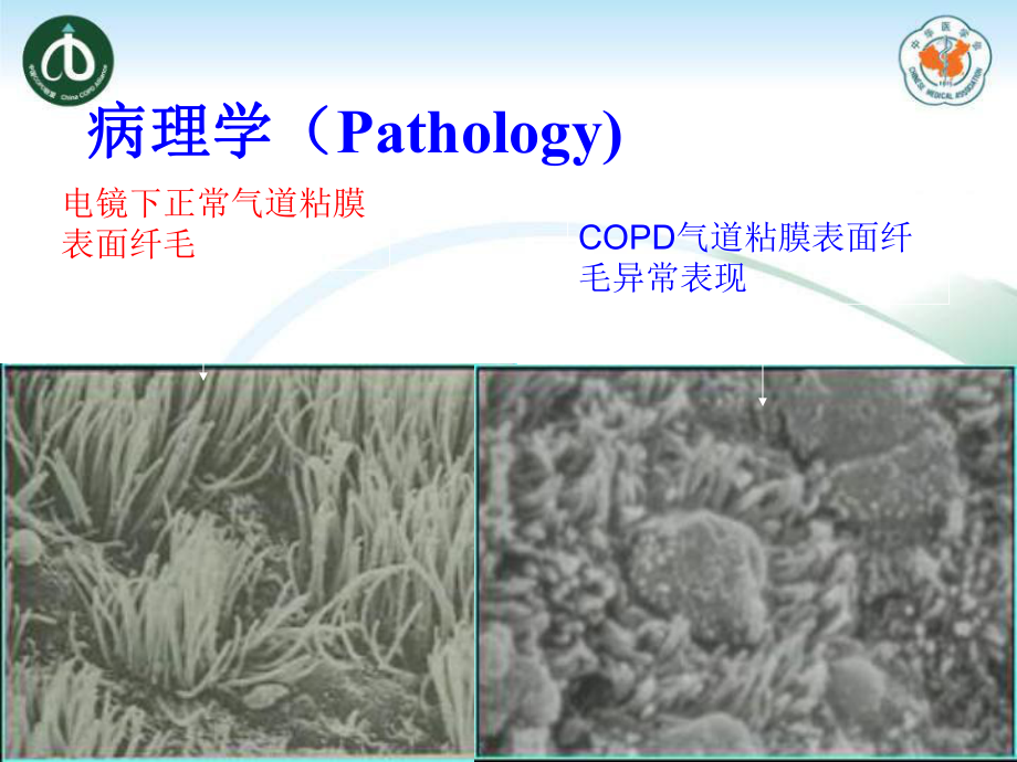 慢性支气管炎10.9班课件.ppt_第3页