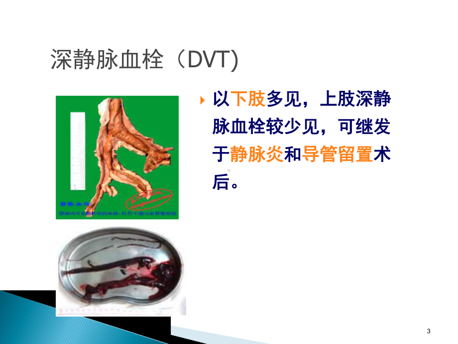 静脉血栓及预防PPT课件.ppt_第3页