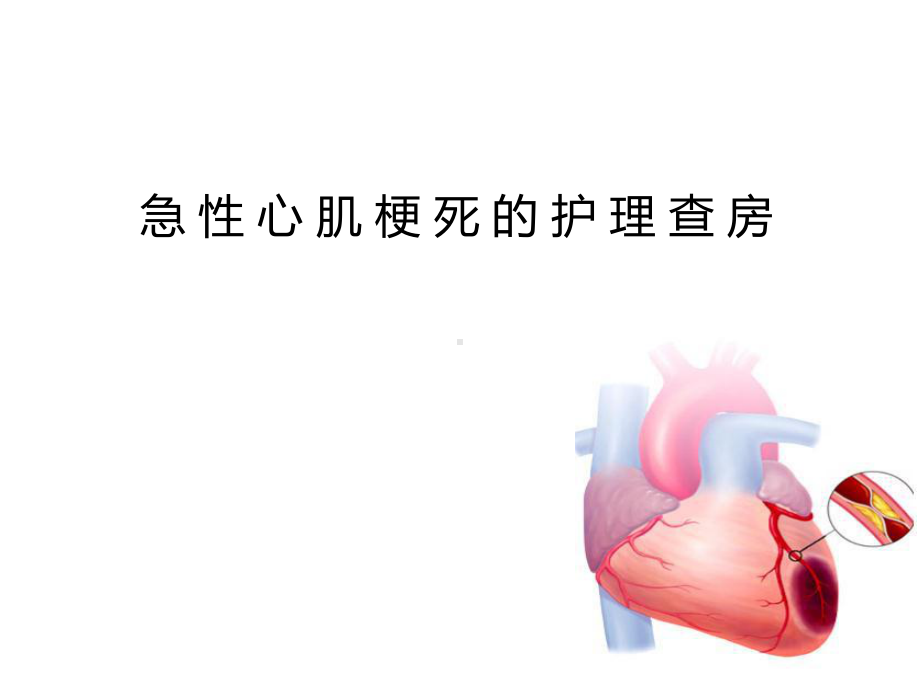 急性心肌梗死的护理查房75931课件.ppt_第1页