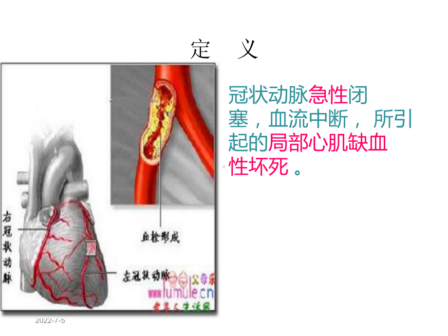 急性心肌梗死的护理查房75931课件.ppt_第3页