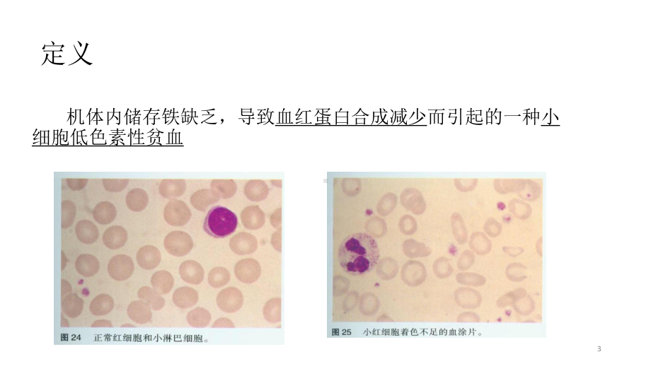 缺铁性贫血PPT课件.ppt_第3页