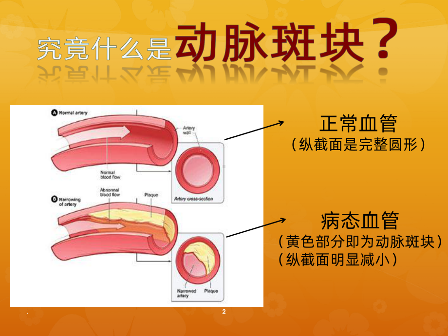 患教-颈动脉斑块PPT课件.pptx_第2页