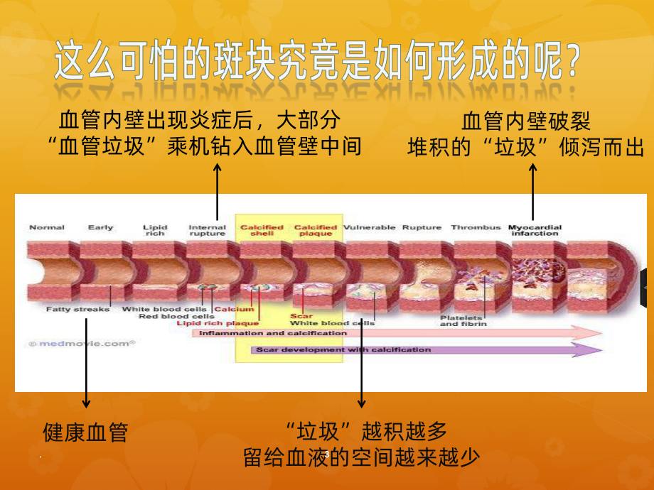 患教-颈动脉斑块PPT课件.pptx_第3页