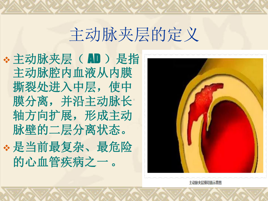 主动脉夹层的急救处理PPT课件.ppt_第3页