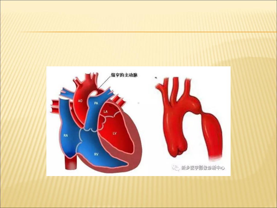 主动脉弓缩窄课件.ppt_第2页